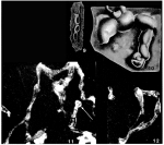Vinelloidea crussolensis Canu, 1913